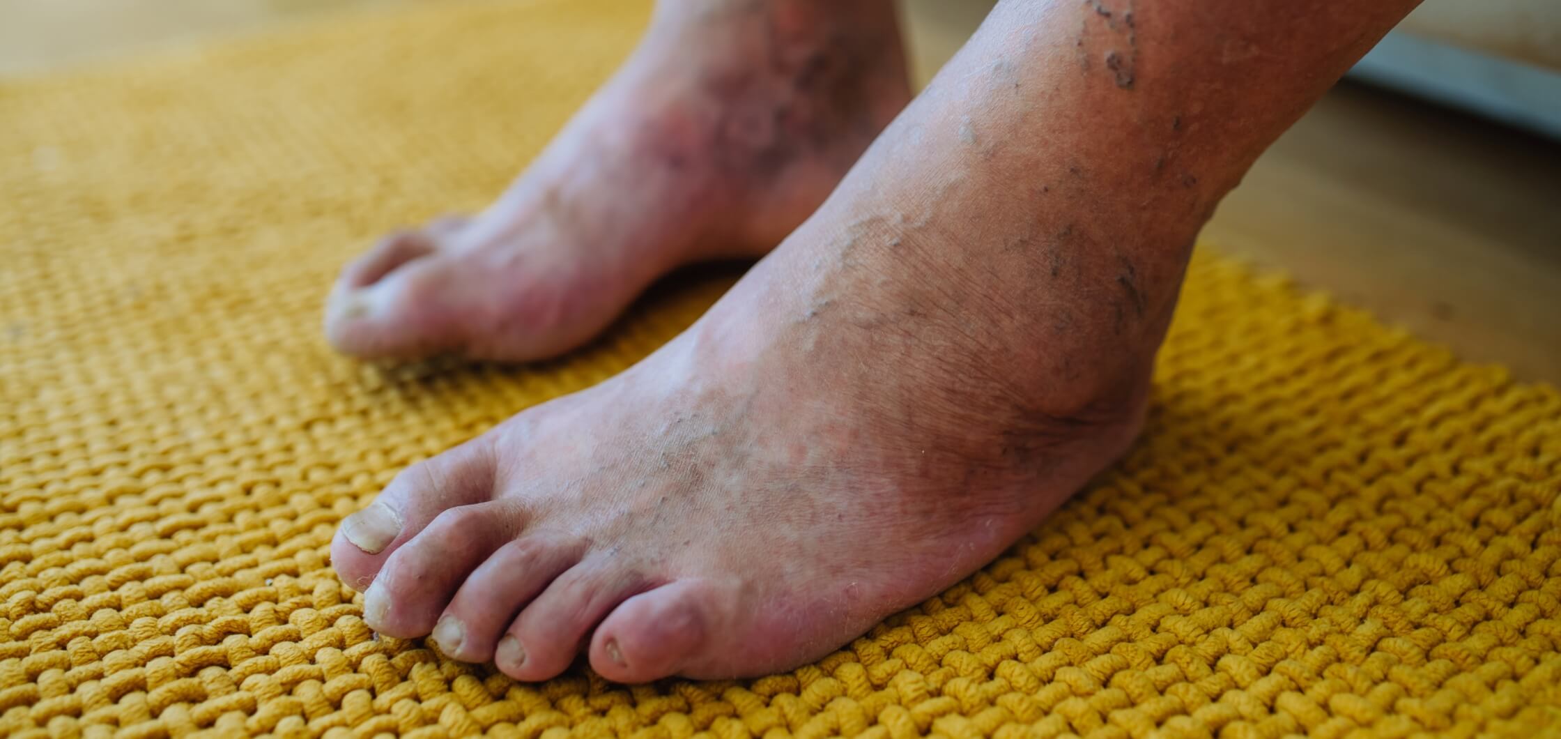 Advanced Diabetic Foot Ulcer Treatment at Home